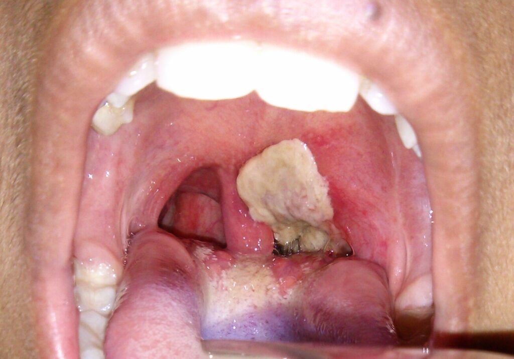 diphtheria e1722382663264